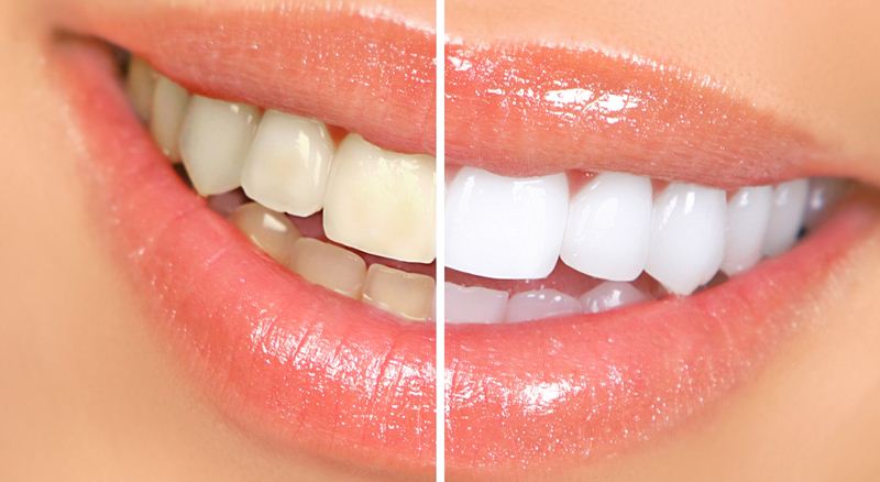 Natural treatment for teeth whitening